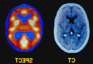 An MRI of a psychiatric patient